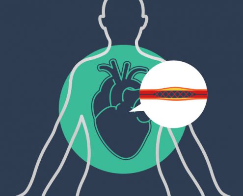 Illustration eines Stents zum Artikel: Jochheim Medizin an Studie zu Herzkatheteruntersuchungen beteiligt